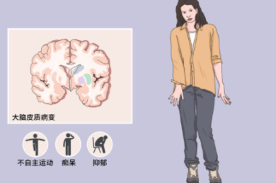患有舞蹈症人的一些明显特点