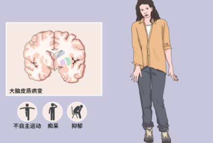 患舞蹈症,舞蹈症人特点